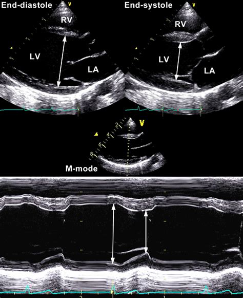 lv end diastolic diameter|lv end diastolic dimension.